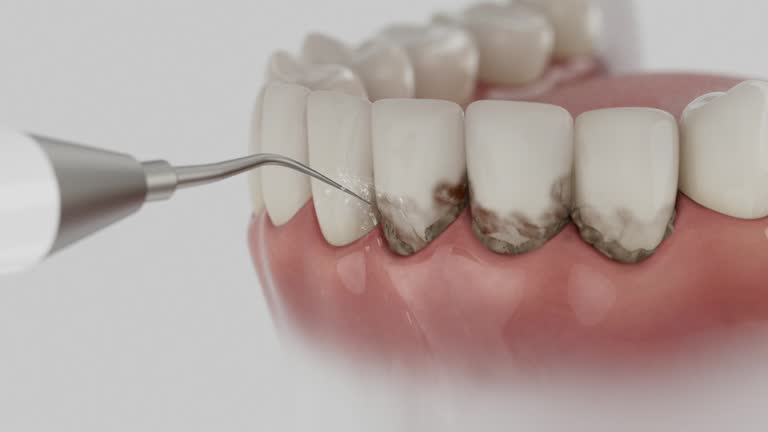 Trusted Wisdom Tooth Removal service in Perezville, TX - Dentist Open Now